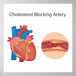 Affiche Vaisseaux sanguins étroits