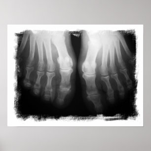 Affiche X-Ray Pieds humains Skeleton Bones noir et blanc