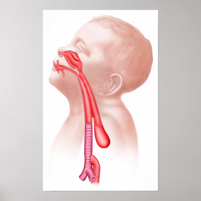 Affiches Anatomie D'Une Fistule Trachéesophagienne (Devant)