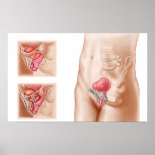 Affiches Anatomy Of Bladder Suspension Procedure