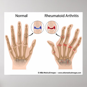 Affiches Arthrite rhumatoïde des articulations du doigt, di
