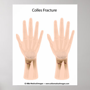 Affiches Colles fracture, medical illustration.