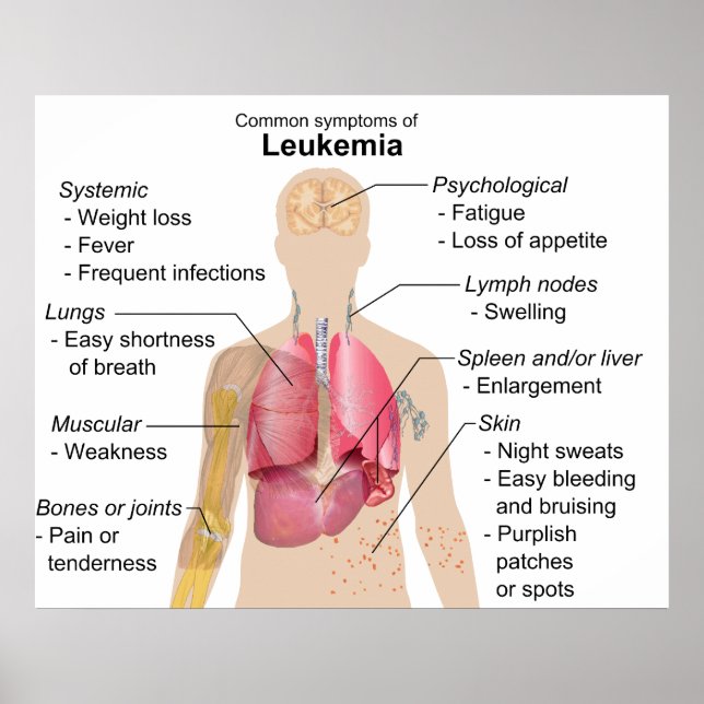 Affiches Common Symptoms Chart of Leukemia Blood Cancer (Devant)