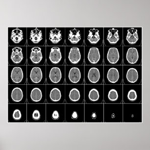 AFFICHES CT SCAN DE TÊTE