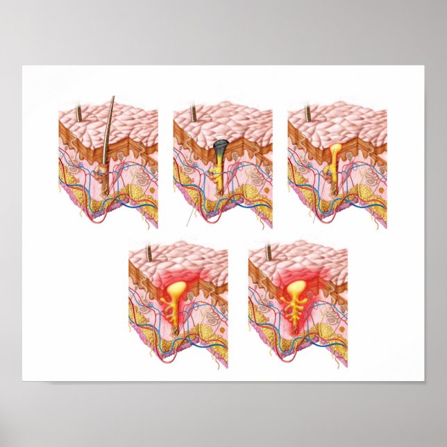 Affiches Différents Types D'Acné (Devant)