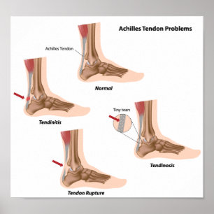 Affiches Douleur de pied Achilles problèmes de tendon Poste