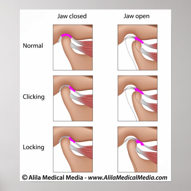 Affiches Dysfonctionnement articulaire temporomandibulaire, (Devant)
