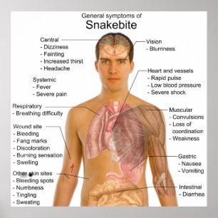 Affiches General Symtoms Chart of a Snakebite Poisoning