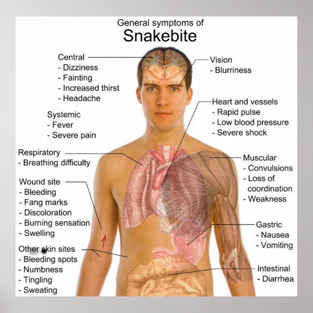 Affiches General Symtoms Chart of a Snakebite Poisoning (Devant)