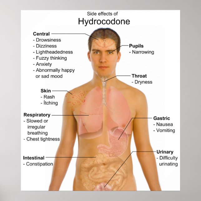 Affiches Graphique des effets secondaires de l'hydrocodone  (Devant)
