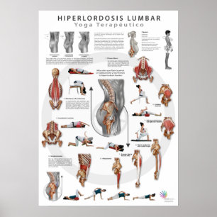 Affiches Hiperlordosis - définition, causes et traitement