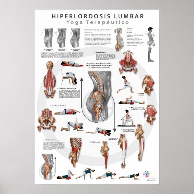 Affiches Hiperlordosis - définition, causes et traitement (Devant)