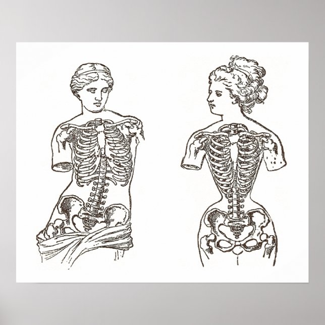 Affiches Impact physique du port des corsets Médicale Impre (Devant)