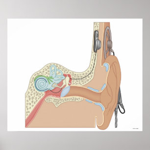 Affiches Implants cochléaires