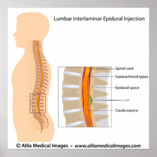 Affiches Injection épidurale Lumbar, diagramme étiqueté.