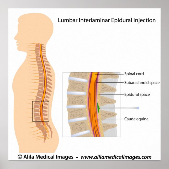 Affiches Injection épidurale Lumbar, diagramme étiqueté. (Devant)
