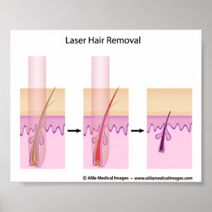 Affiches Laser hair removal procedure