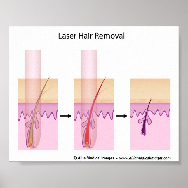 Affiches Laser hair removal procedure (Devant)