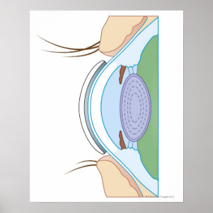 Affiches Lentilles de contact souples