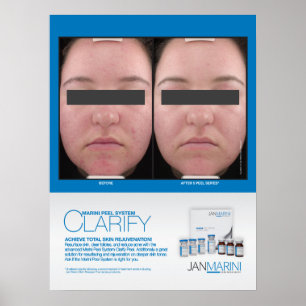 Affiches Marini Peel Clarify Résultats 18x24"