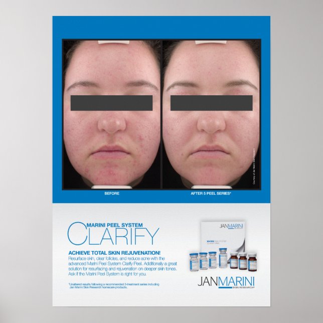 Affiches Marini Peel Clarify Résultats 18x24" (Devant)