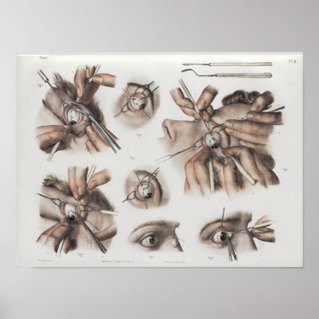 Affiches Optométrie de chirurgie oculaire Anatomie Vintage  (Devant)