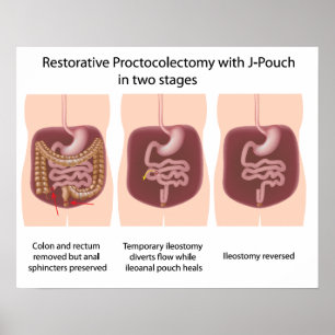 Affiches Proctocolectomie réparatrice avec j-pouch 2 étapes