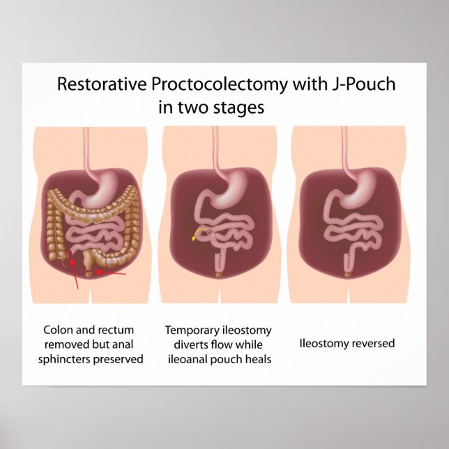 Affiches Proctocolectomie réparatrice avec j-pouch 2 étapes (Devant)