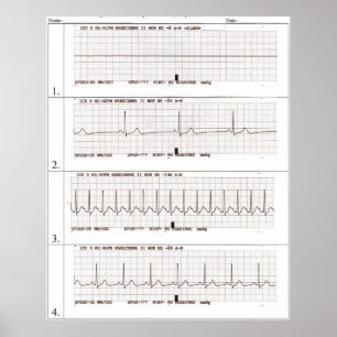 Affiches rythmes ekg