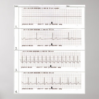 Affiches rythmes ekg
