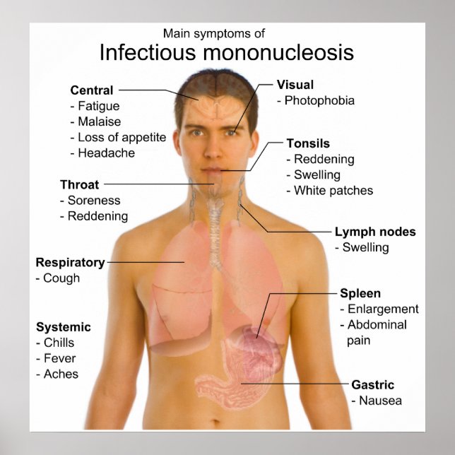 Affiches Symptômes principaux de la mononucléose infectieus (Devant)