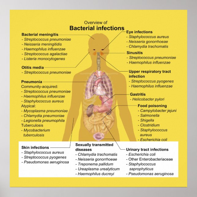 Affiches Vue d'ensemble des infections bactériennes (Devant)