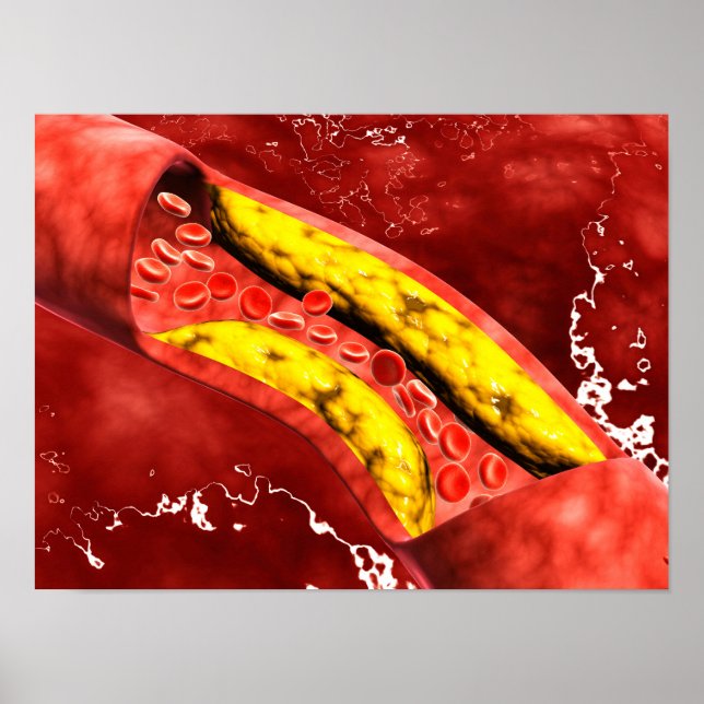 Affiches Vue Microscopique De Plaque Grasse À L'Intérieur D (Devant)