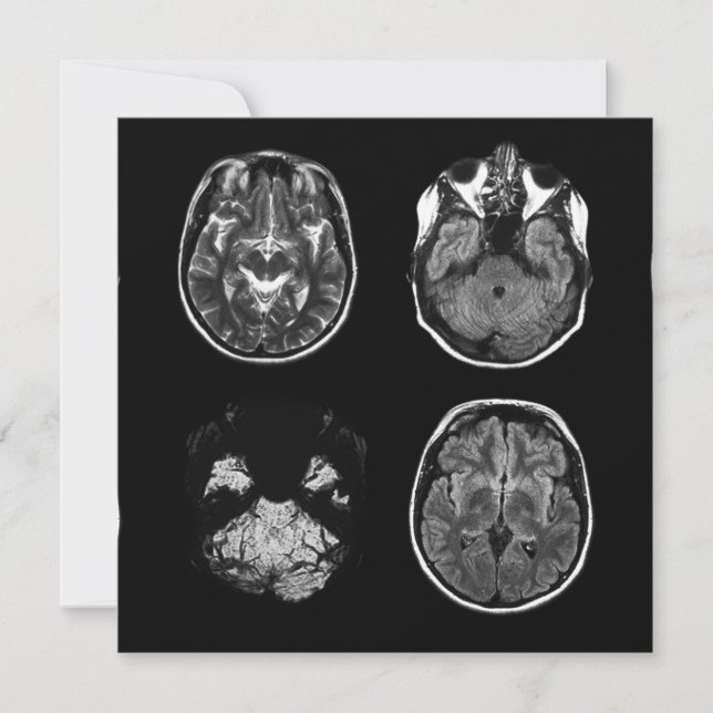 Analyse IRM du cerveau (Devant)