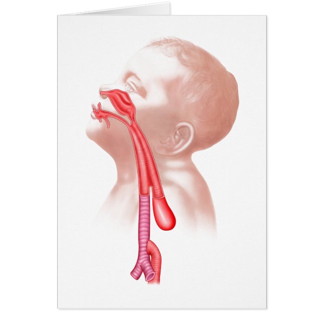 Anatomie D'Une Fistule Trachéesophagienne (Devant)