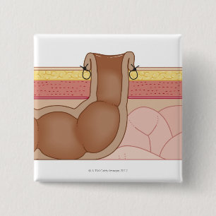 Badge Carré 5 Cm Colostomie permanente