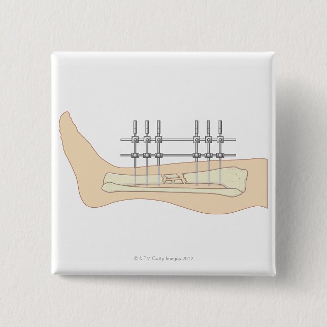 Badge Carré 5 Cm Fixateur externe (Devant)