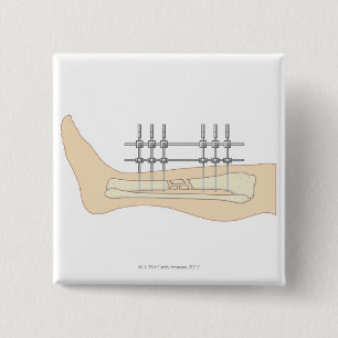 Badge Carré 5 Cm Fixator externe