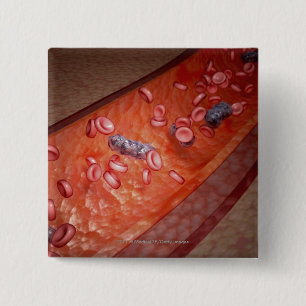 Badge Carré 5 Cm Rendu microscopique d'une infection de sang