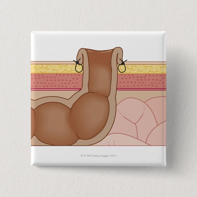 Badge Carré 5 Cm Une colostomie permanente (Devant)