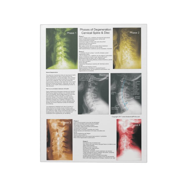 Bloc-note Éteindre Dégénérescence cervicale de la colonne ve (Tourné)