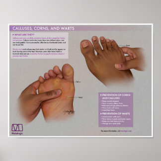Callus, cornes et tourbières mélalogiques Poster M