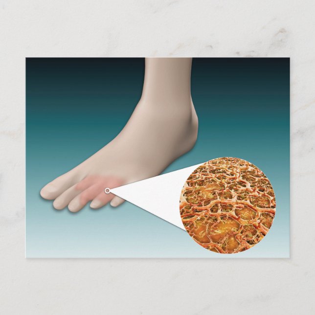 Carte Postale Anatomie Des Fungus Pieds Avec Agrandissement Micr (Devant)