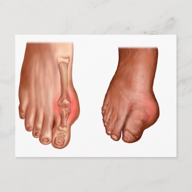 Carte Postale Anatomie D'Un Pied Gonflé (Devant)