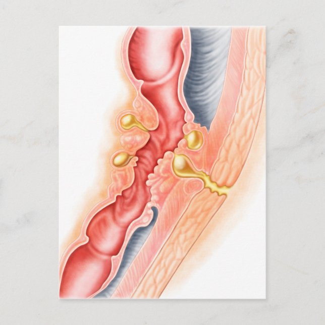 Carte Postale Développement De La Fistule (Devant)