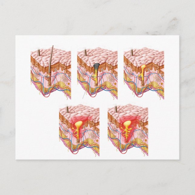 Carte Postale Différents Types D'Acné (Devant)