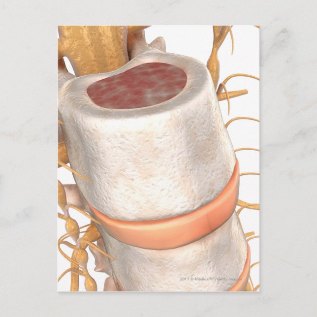 Carte Postale Fermer un disque invertébral dans la colonne verté (Devant)