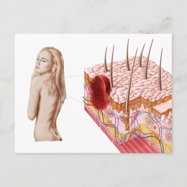 Carte Postale Illustration D'Une Croissance Atypique Sur La Peau (Devant)