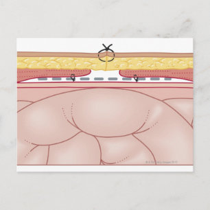 Carte Postale Illustration d'une hernie