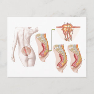 Carte Postale Illustration Médicale D'Un Cyst Pilonidal